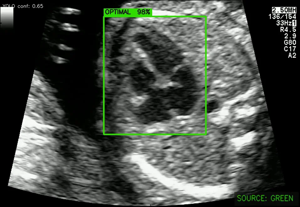 Ultrasound frame with a green bounding box labeled "optimal" around a clear four-chamber view of the fetal heart