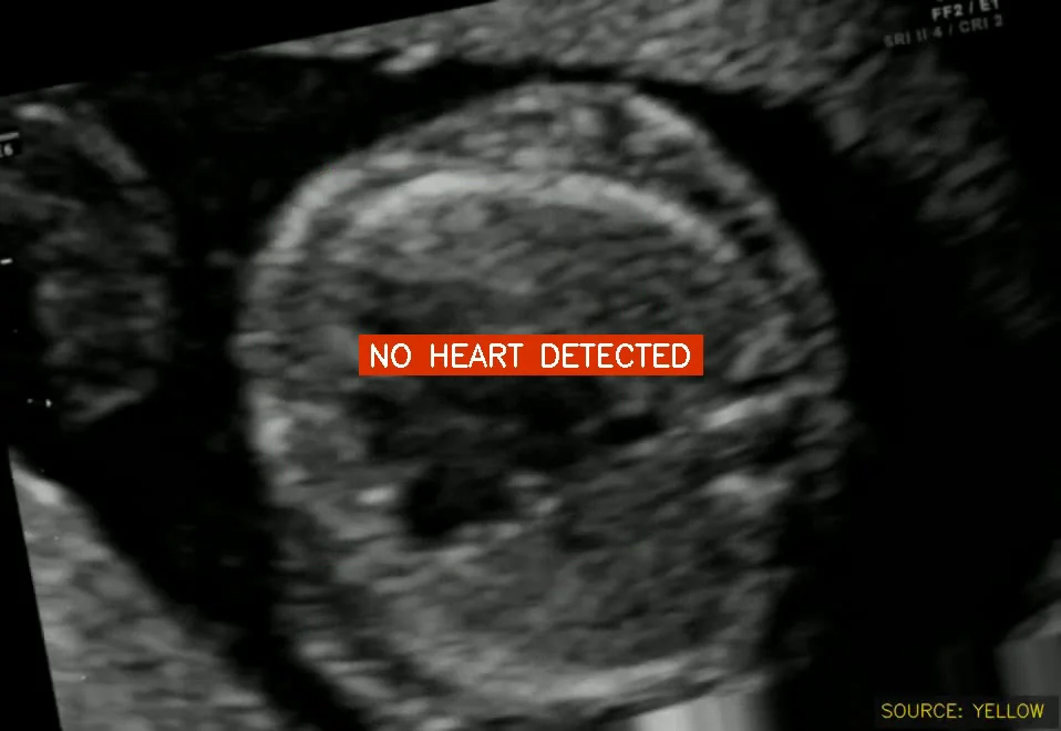 Ultrasound frame where the system shows a red "no heart detected" message, telling the operator to keep looking