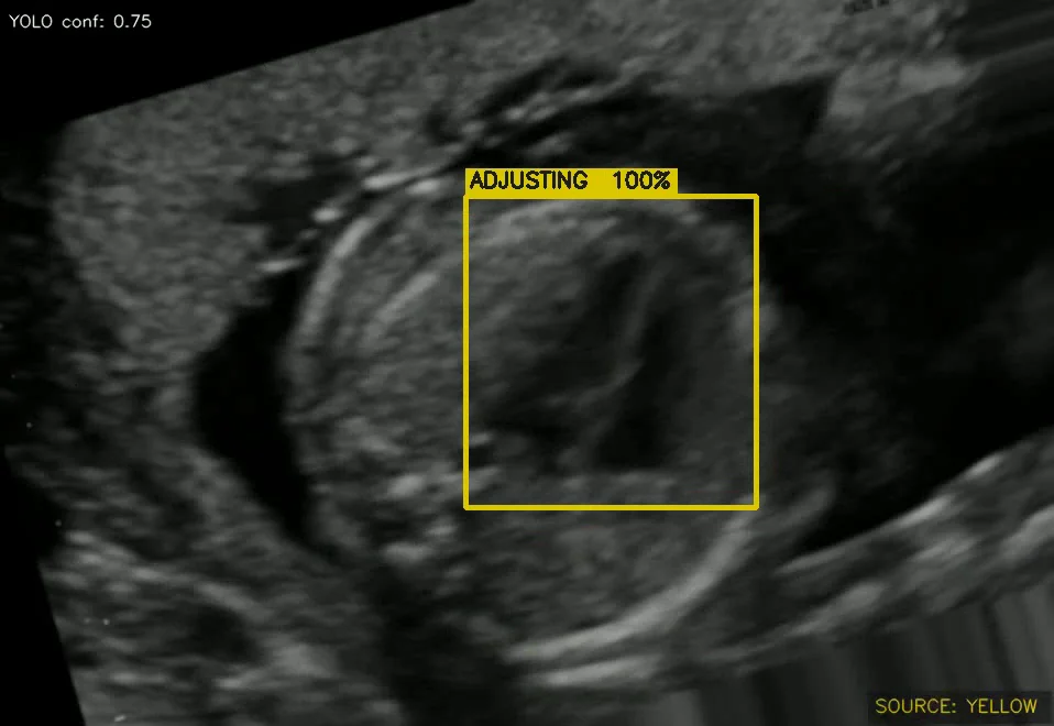 Ultrasound frame with a yellow bounding box labeled "adjusting", indicating the view needs small adjustments